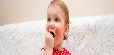 8e3f67418d2341cfda20afd40d442d34-1 التدابير العلاجية للأكزيما التي تصيب الأطفال