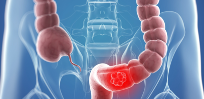 90bf7b5c834a47c3ce3669d15ad5e93b-1 الفحوصات المهمة للوقاية من سرطان القولون