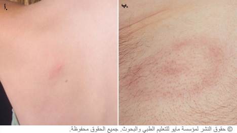 داء لايم داء لايم