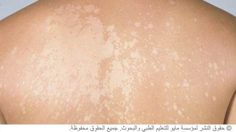 التينيا الملونة التينيا الملونة