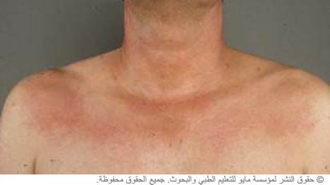 عُشْبَة الخنْازِير عُشْبَة الخنْازِير