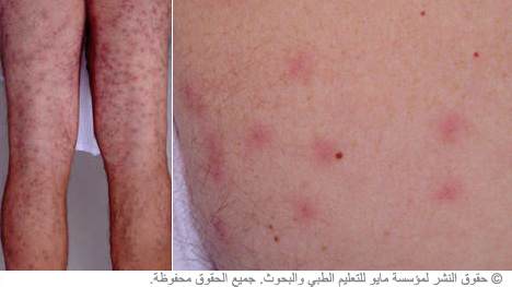 حكة السباحين حكة السباحين