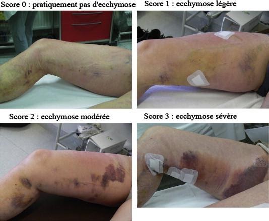 ac8d936d89547a5f3abfce23c665d5ae المنظر بعد علاج الدوالي بالليزر الجراحي