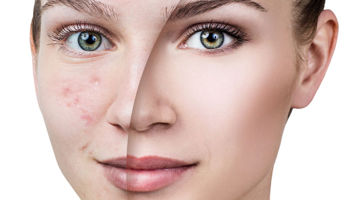 موقع طبابة نت - علاج حب الشباب والتخلص من آثاره