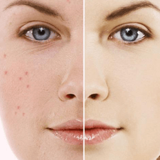 acne 1.tتناول الوجبات السريعة يؤثر في ظهور حب الشباب؟