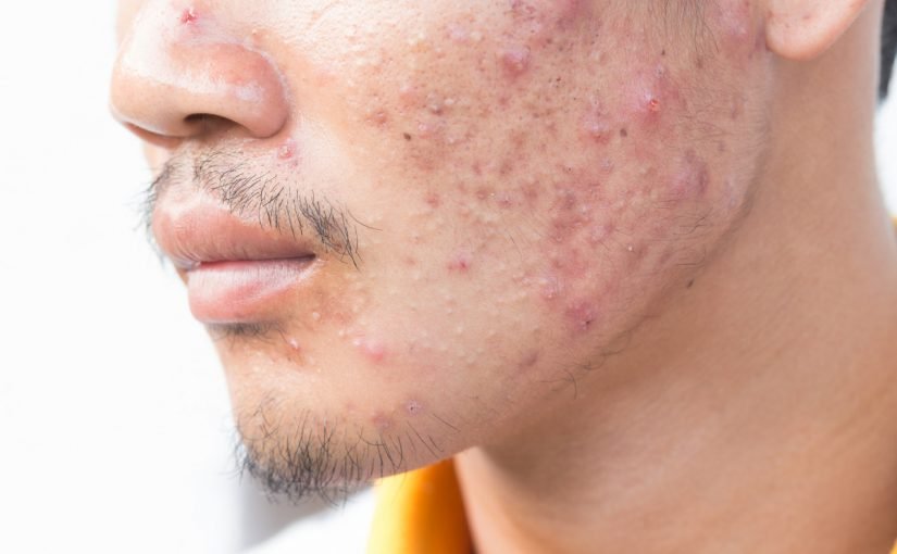 adobestock_117012893-825x510-2 كيفية ازالة حب الشباب من الوجه