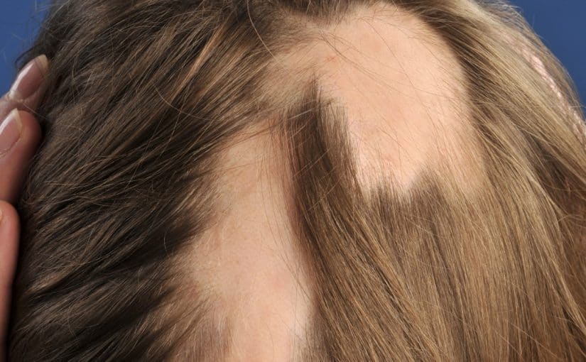 alopecia-areata-4-825x510-2 افضل علاج للثعلبة