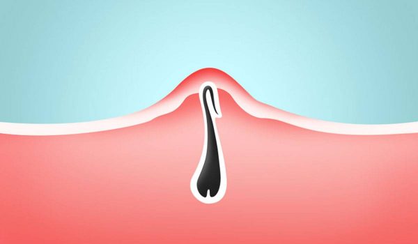 نمو الشعر تحت الجلد Ingrown Hairs 