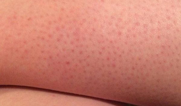 مطبات الحلاقة Shaving Bumps