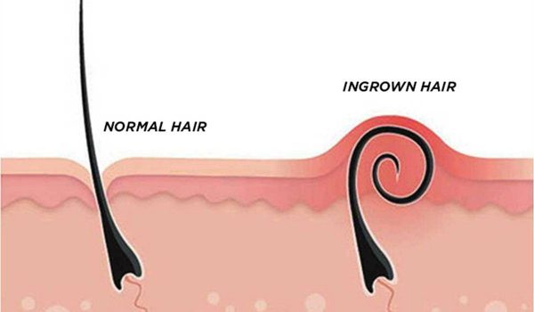 كيف اتخلص من الشعر تحت الجلد