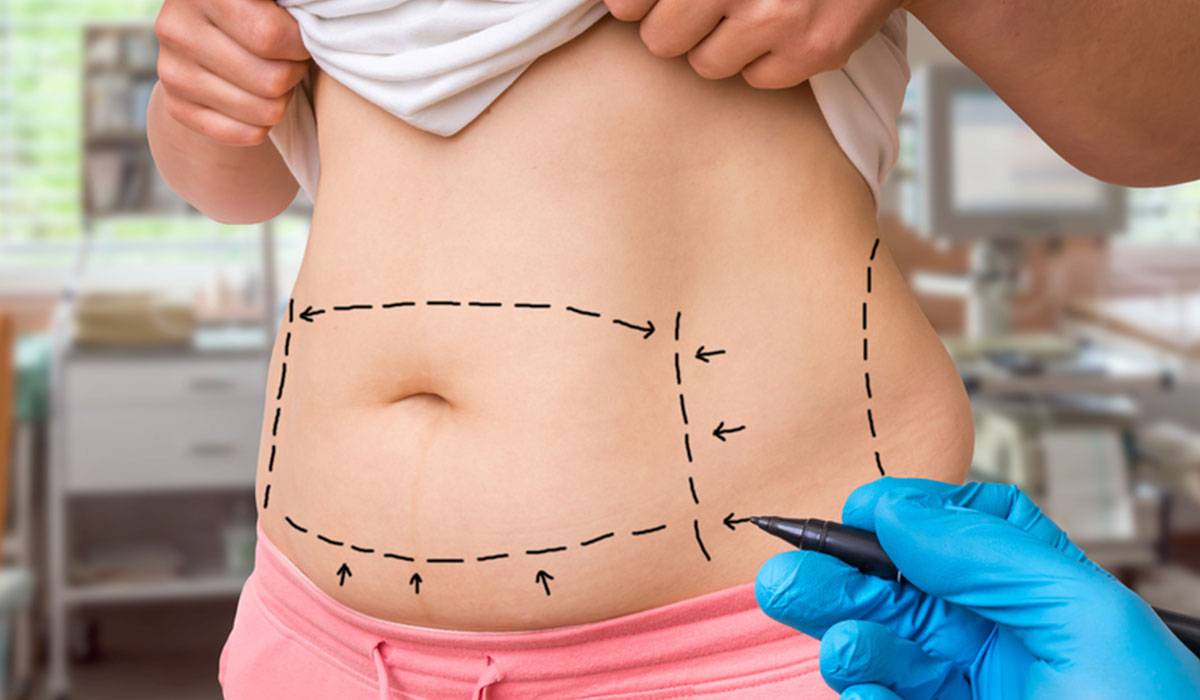 عملية شد البطن