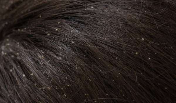 علاج قشرة الشعر الجاف