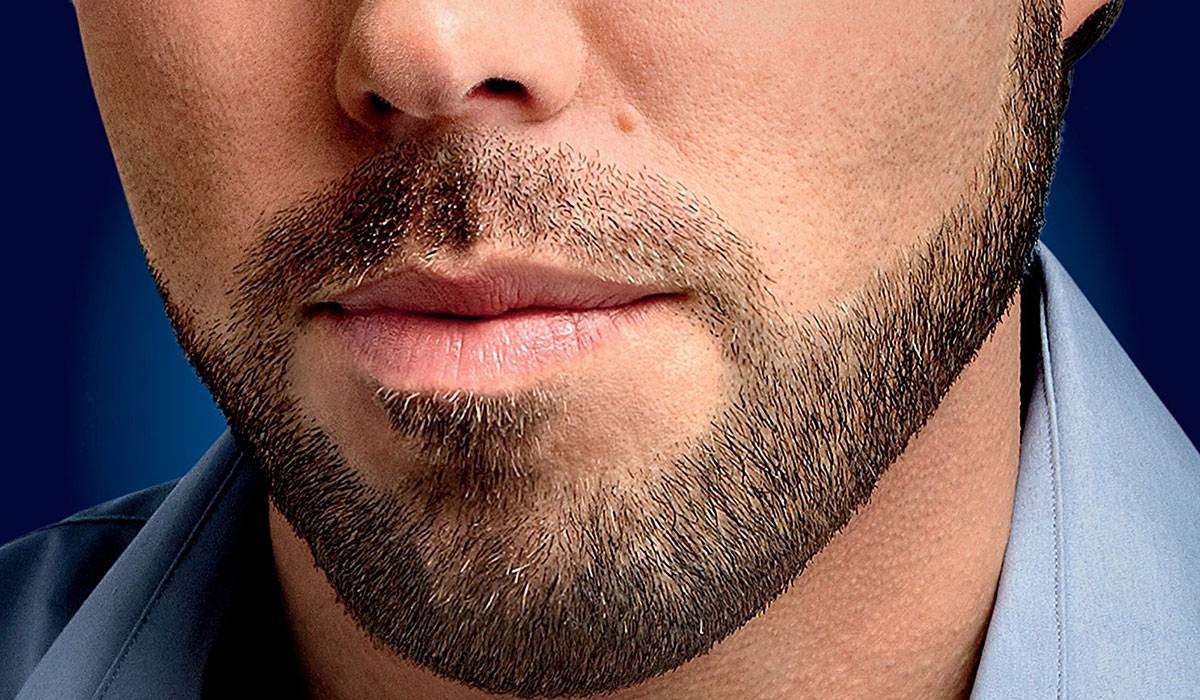 تحديد اللحية بالليزر