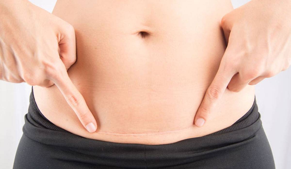 كيفية علاج التهاب العملية القيصرية