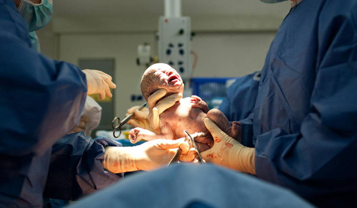 فوائد الولادة القيصرية