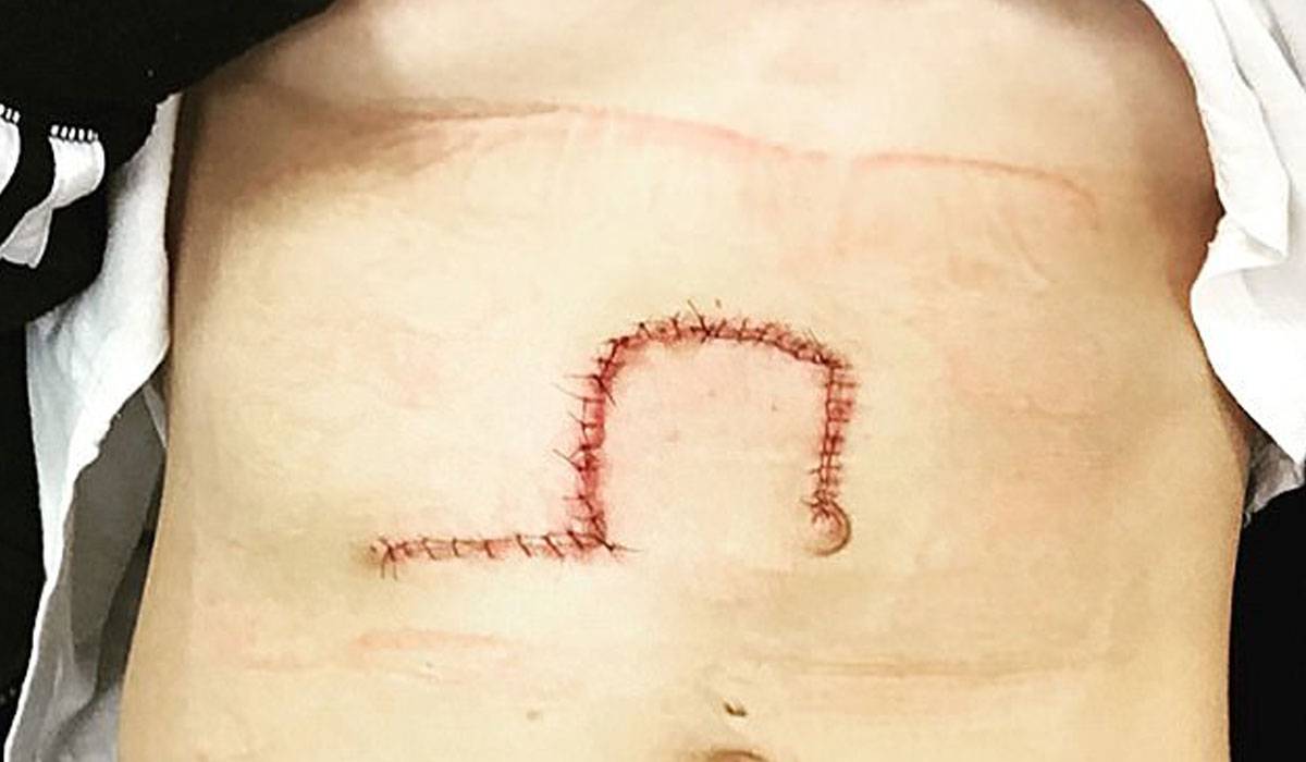 سرطان الجلد