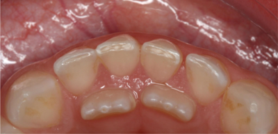 b04eed0b63bf7f78501de4d0a6685b4b-1 ظهور أسنان خلفية لدى الطفل: هل تستدعي القلق؟