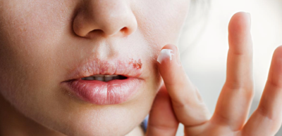 b9add3c6a7ee4fe156acc79b91832e9d-1 قروح البرد