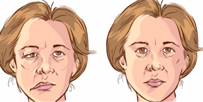 ba064bd089ff346eacab9097b0c444ec-1 العصب السابع يشل الوجه.. والعلاج يكون بالوقاية والتدليك