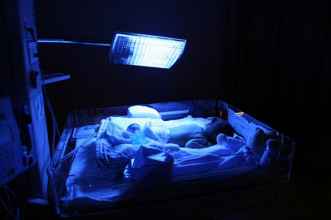 Image result for treatment of newborn jaundice