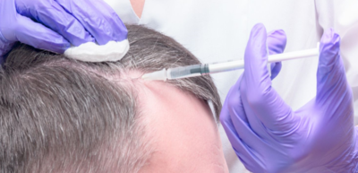 bdb6a88db50a99f9352375463fe1eb90-1 حقن البلازما للشعر