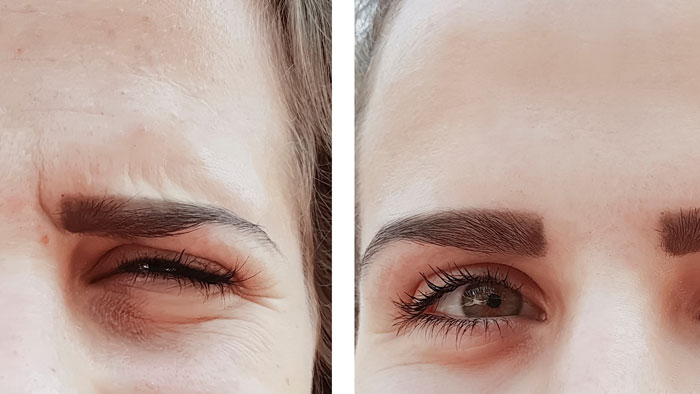 botox-4 طبابة نت - أشياء مهمة عن البوتوكس