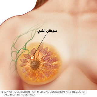 المرحلة الأولى من سرطان الثدي المرحلة الأولى من سرطان الثدي