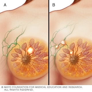 المرحلة الثانية من سرطان الثدي المرحلة الثانية من سرطان الثدي