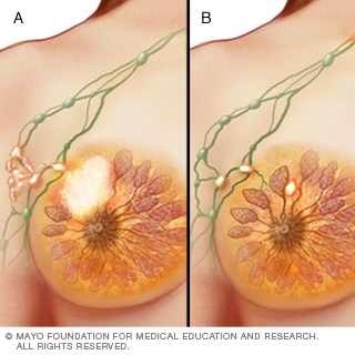 المرحلة الثالثة من سرطان الثدي المرحلة الثالثة من سرطان الثدي