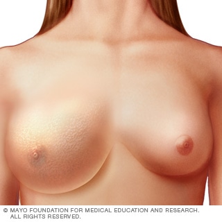 التهاب سرطان الثدي التهاب سرطان الثدي