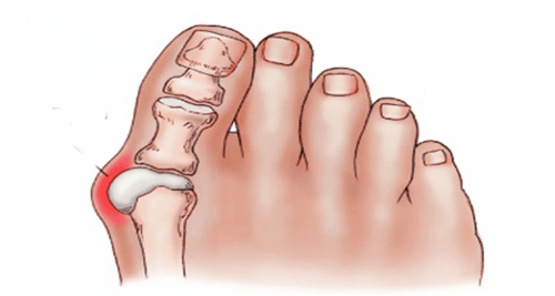 bunion-1