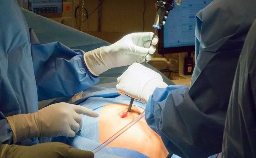 c0300171-appendix_removal_surgery-spl1-825x510-2 عملية شفط الدهون