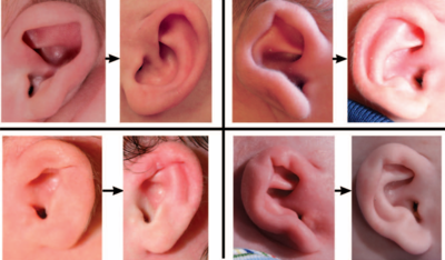 c2b9cc4a68cd6963b4d5ac09215c951b-1 تشوهات الاذن وكيفية معالجتها