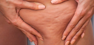 طرق الوقاية من السيلوليت وعلامات التمدد بالجلد