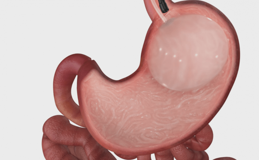 capture-825x510-2 بالون المعدة