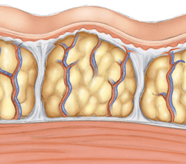 causes_of_cellulite-2-380x335-1 3.أسباب السلوليت :