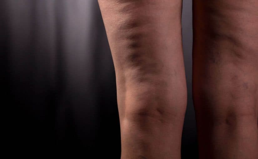 cellulite-825x510-2 السيلوليت