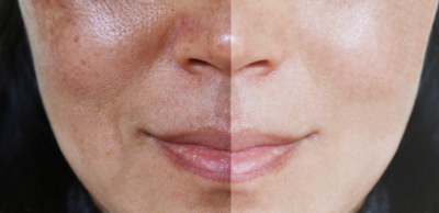 d7e44052d5c0d5b748418e3a65538298-1 الغذاء وكلف الوجه