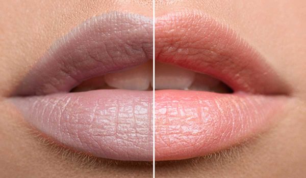 أسباب الشفاه الداكنة