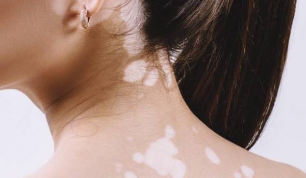 أعراض البهاق