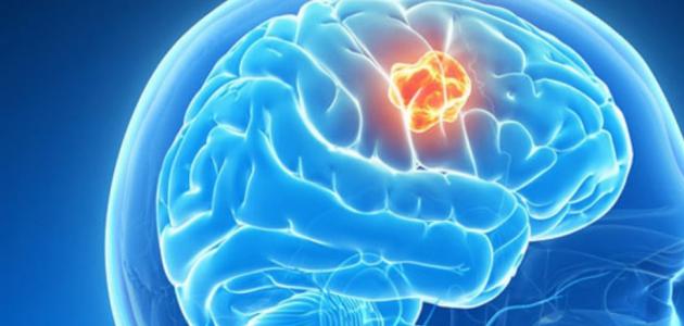 أعراض ورم الدماغ