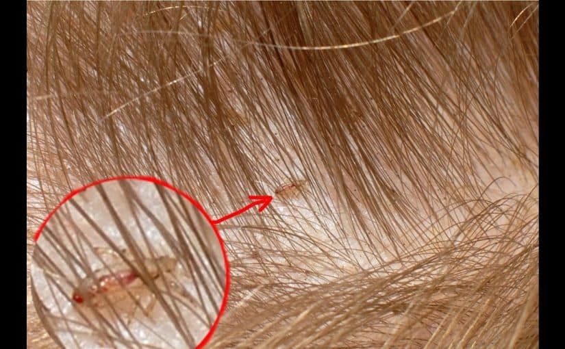 أفضل خلطه تروح القمل