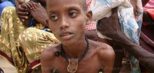 أمراض سوء التغذية