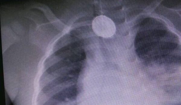 d8a5d8a8d8aad984d8a7d8b9-d8a8d8b7d8a7d8b1d98ad8a9 إبتلاع بطارية