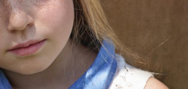 إنتفاخ الخد