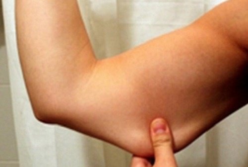 ارتخاء الجلد أسفل الذراع