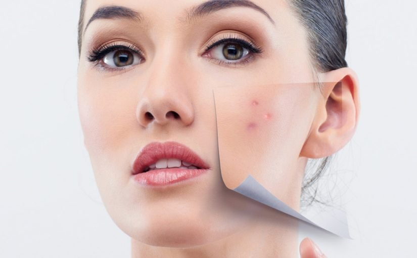 d8a7d8b2d8a7d984d8a9-d8add8a8-d8a7d984d8b4d8a8d8a7d8a8-825x510-2 كيفية ازالة حب الشباب نهائيا