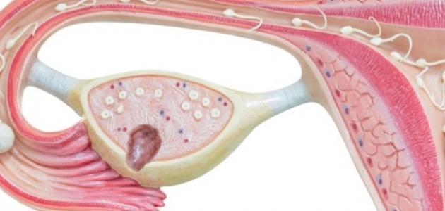 اسباب اكياس الماء على المبيض