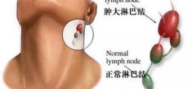 اعراض التهاب الغدد اللمفاوية