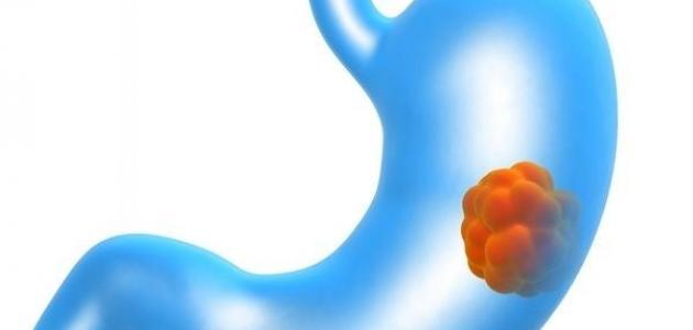 اعراض مرض سرطان المعدة